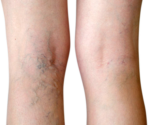 Vein Therapy Varicose Vein Treatment Spider Vein Removal Dayton OH