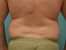Patient B01 Before Thumbnail