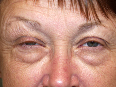 Laser Treatments Dayton OH Patient 36 Before