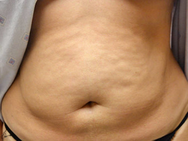 Liposuction Dayton OH Patient 39 Before