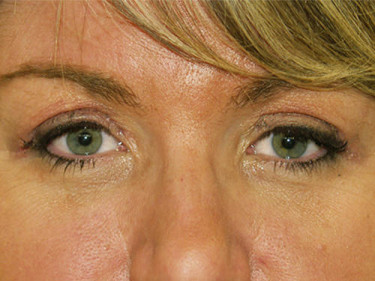 Blepharoplasty Dayton OH Patient 10 After