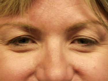 Blepharoplasty Dayton OH Patient 10 Before