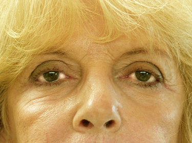 Blepharoplasty Dayton OH Patient 11 After