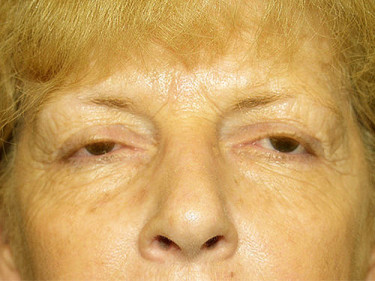 Blepharoplasty Dayton OH Patient 11 Before