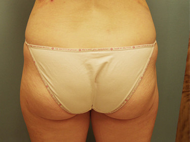 Liposuction Dayton OH Patient 61 After