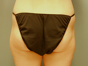 Liposuction Dayton OH Patient 61 Before