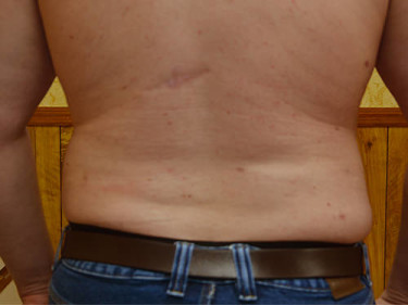 Liposuction Dayton OH Patient 62 After