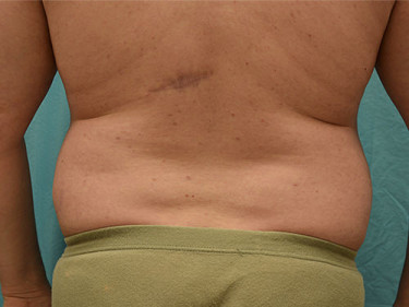 Liposuction Dayton OH Patient 62 Before