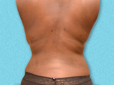 Liposuction Dayton OH Patient 102 After