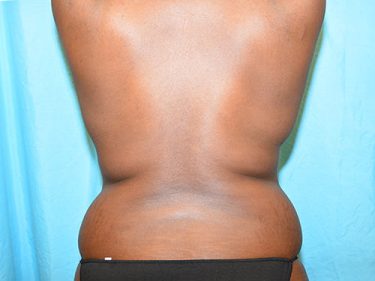 Liposuction Dayton OH Patient 102 Before