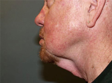 Neck Lift Dayton OH Patient 68 Before