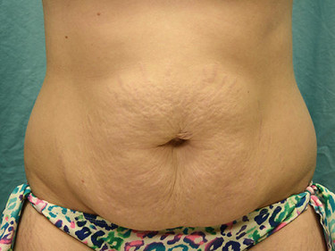 Tummy Tuck Dayton OH Patient 74 Before
