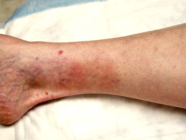 Vein Therapy Dayton OH Patient 76 After
