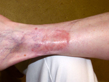 Vein Therapy Dayton OH Patient 76 Before