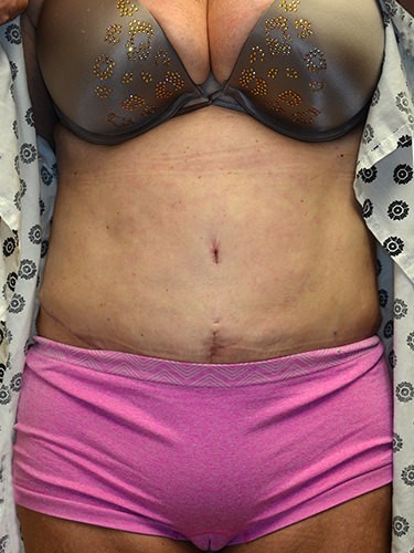 Tummy Tuck Dayton OH Patient 94 After