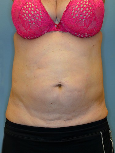 Tummy Tuck Dayton OH Patient 94 Before