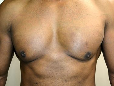 Liposuction Dayton OH Patient 103 After