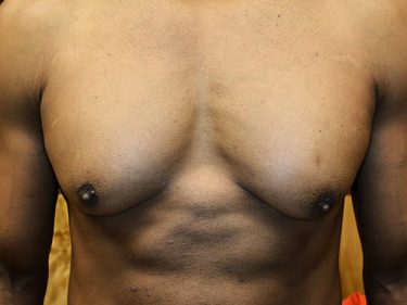 Liposuction Dayton OH Patient 103 Before