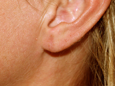 Earlobe Repair Dayton OH Patient 20 After