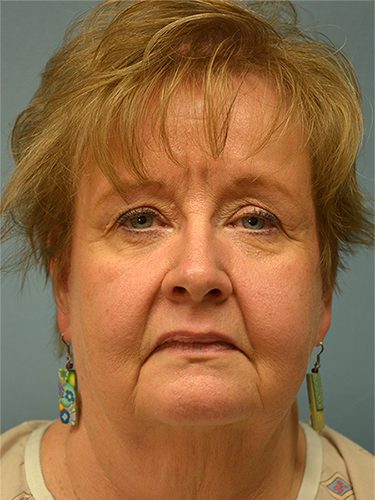 Facelift Dayton OH Patient 111 Before
