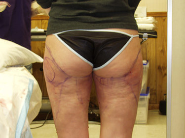 Laser Liposuction Dayton OH Patient 30 After