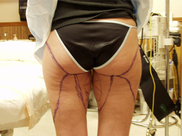 Laser Liposuction Dayton OH Patient 30 Before