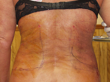 Laser Liposuction Dayton OH Patient 32 After