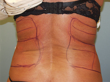 Laser Liposuction Dayton OH Patient 32 Before