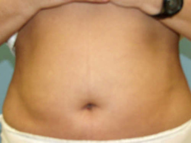 Liposuction Dayton OH Patient 39 After