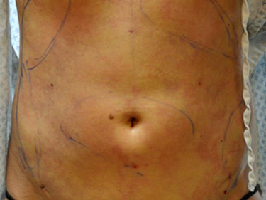 Liposuction Dayton OH Patient 40 After