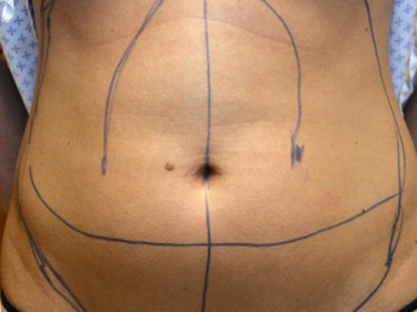 Liposuction Dayton OH Patient 40 Before