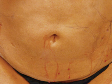 Liposuction Dayton OH Patient 41 After