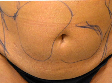 Liposuction Dayton OH Patient 41 Before