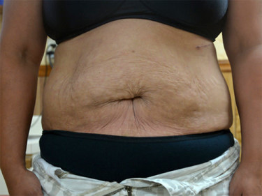 Liposuction Dayton OH Patient 42 After