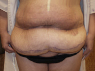Liposuction Dayton OH Patient 42 Before