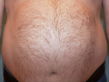 Liposuction Dayton OH Patient 43 Before
