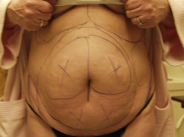 Liposuction Dayton OH Patient 58 Before