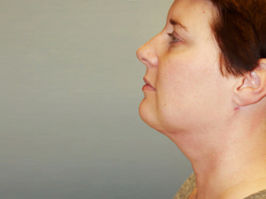 Neck Lift Dayton OH Patient 71 Before