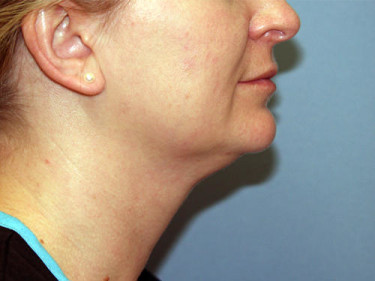 Neck Lift Dayton OH Patient 73 Before
