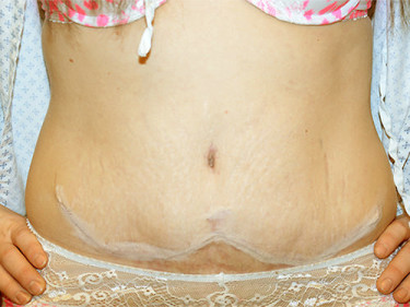 Tummy Tuck Dayton OH Patient 74 After