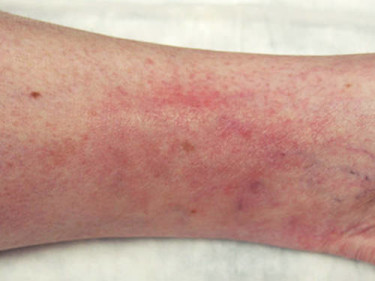 Vein Therapy Dayton OH Patient 77 After
