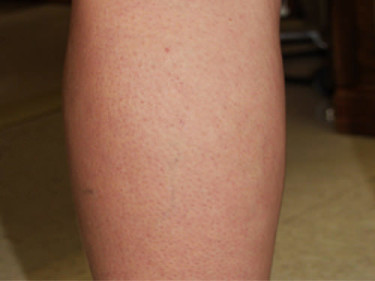 Vein Therapy Dayton OH Patient 78 After