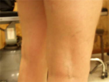 Vein Therapy Dayton OH Patient 79 After