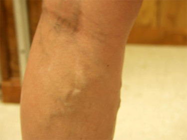 Vein Therapy Dayton OH Patient 79 Before