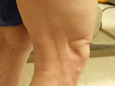 Vein Therapy Dayton OH Patient 80 After