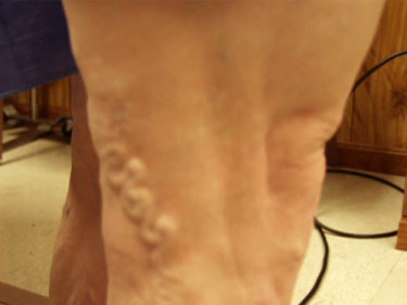 Vein Therapy Dayton OH Patient 80 Before