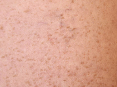 Vein Therapy Dayton OH Patient 81 After