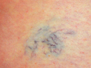 Vein Therapy Dayton OH Patient 81 Before