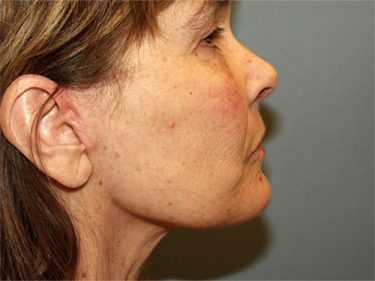 Facelift Dayton OH Patient 130 After