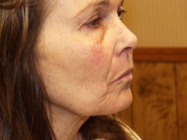 Facelift Dayton OH Patient 130 Before
